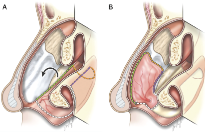 Fig. 1. (A) Illustration depicting the exposed quadrangular cartilage donor site after nasoseptal flap harvest with outline of inferior meatus mucosal flap incisions and counterclockwise rotation. (B) Inferior mucosal flap rotated into position, covering the quadrangular cartilage. Note that the flap covers the superior area next to the nasal dorsum, which is a critical area that can lead to cicatricial contraction and saddle nose if left uncovered..