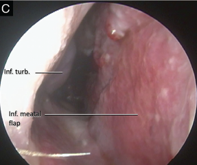 Fig. 2. (C) One month post-operative image showing well healed flap and no evidence of dehiscence.