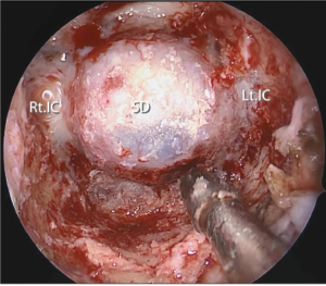 Fig. 1. Final endoscopic view after resection of the anterior wall of the sphenoid sinus including the PVC to the medial edge of the Vidian canal. Note the inferolateral part of the anterior sphenoidotomy is maximized, expanding the working corridor for surgical instruments. SD = sellar dura; Lt. IC = left internal carotid artery; Rt. IC = right internal carotid artery.