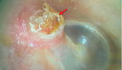 Figure 1a. Preoperative otoscopic examination (red arrow: pars flaccida cholesteatoma).