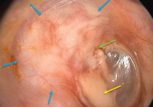 Figure 1b. Postoperative otoscopic examination after 1 year (blue arrows: margins of the epitympanic obliteration; green arrow: contact with the malleus; yellow arrow: ossiculoplasty using cartilage).