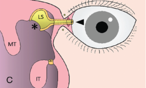 Figure 1. Schematic diagram of the surgical findings of conjunctivoductivo-dacryocystorhinostomy. (IT = inferior turbinate; LD = lacrimal duct; LS = lacrimal sac; MT = middle turbinate.) Here, the tip of the severed nasolacrimal duct is withdrawn into and sutured to the conjunctiva incision (arrowhead). The medial wall of the lacrimal sac is trimmed and the lacrimal sac is widely opened (asterisk).