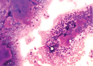 A fine needle aspiration cytology of a benign mixed tumor of the salivary gland (pleomorphic adenoma).