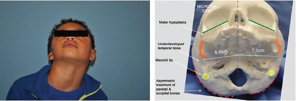 Figure 1. Left: preoperative image demonstrating degree of hemifacial microsomia highlighted by deficient mastoid and asymmetric midface and mandible. Right: 3D-printed skull highlighting these changes at the bony level.