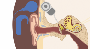cochlear implant