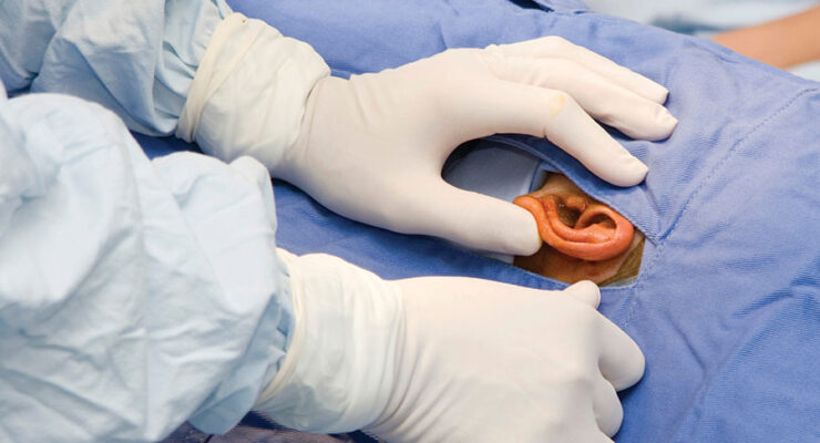 Endoscopic Ear Surgery: Advancements and Adoption Challenges 