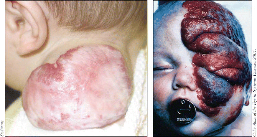 Figure. Some hemangiomas, such as large neck hemangiomas (left) or periorbital hemangiomas (right), require management beyond observation because of their potential to be disfiguring, damaging, or even life-threatening.