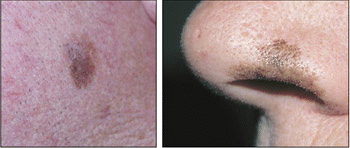 Figure. If not treated properly, lentigo maligna (left) can recur as lentigo maligna melanoma (right).Stedman's (left) Goodheart's Photoguide of Common Skin Disorders, Lippincott Williams & Wilkins (right).