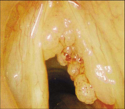 Figure. In the patient with papillomatosis, the view on the fiberoptic scope will show multiple lesions with grapelike projections on the vocal cords.