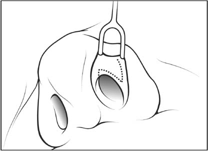 Figure. Intranasal Z-plasty involves the creation and transposition of two triangular flaps.