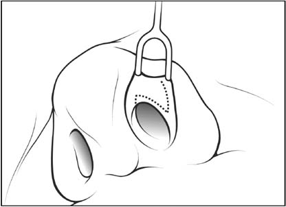 Z-plasty May Be Effective Option for Nasal Valve Collapse ...