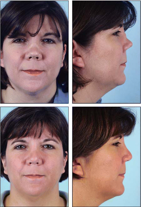 Figure. Pre- and postoperative photographs of a patient of Ira Papel, MD, who underwent revision rhinoplasty using auricular cartilage grafts.