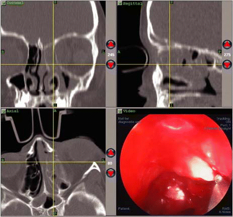 Figure. Image guidance uses data acquired during preoperative CT scans and downloaded into a computer work station to construct multiplanar views of the patient's sinuses.