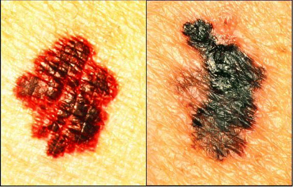 Figure. For tumors such as melanoma that metastasize via the lymphatic system, a negative sentinel node should indicate that the tumor has not spread beyond the initial tumor bed and that all nodes in the nearby basin will be negative.