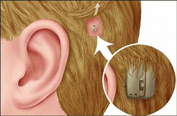 Figure. The BAHA consists of a sound processor attached to an external abutment, which is held in place by a titanium screw implanted into the skull behind the ear.