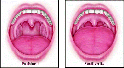 Figure. The Friedman Tongue Position, an anatomy-based staging system, is a simple, noninvasive way of gathering information about the structure of the palate and the tongue and where obstruction is occurring.