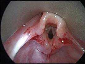 Figure. A postoperative view of the same larynx after having undergone a microdebrider supraglottoplasty. Note the improved visualization of the true vocal folds after cutting the bilateral aryepiglottic folds and trimming the redundant arytenoid mucosa with a microdebrider.