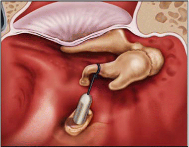 Stapes Surgery