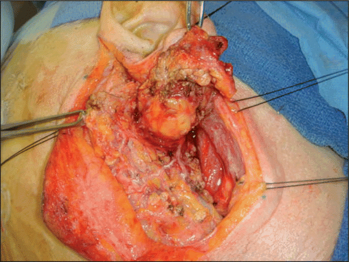 Figure. Closeup of a parotidectomy in progress. Photo courtesy of Dr. David Eisele.
