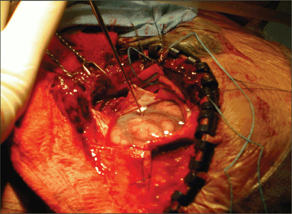 Figure 2. This picture reveals a right temporal craniotomy with exposure to Heschl's gyrus and the auditory cortex. The hand-held neuronavigation device is coupled with the magnetoencehpalographic and fMRI images to facilitate precise placement of the intracortical electrodes.
