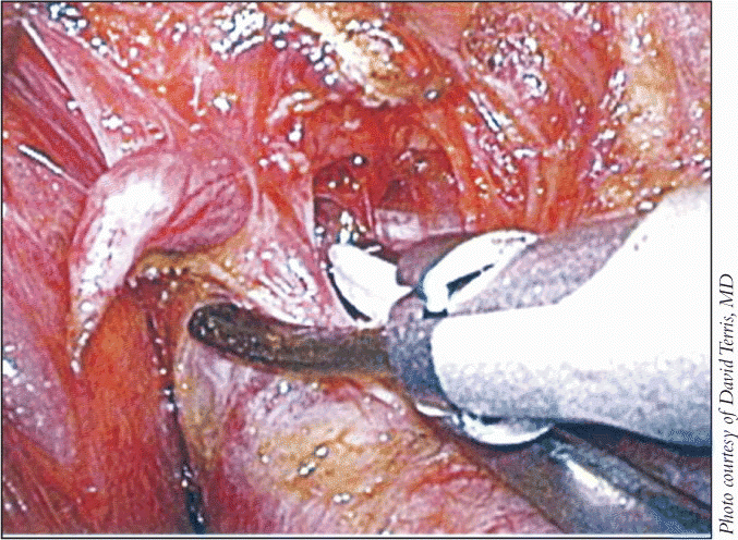Figure. Reliable ligation of the upper pedicle with a low-profile instrument is critical, and achieved with an ultrasonic device such as the Harmonic.