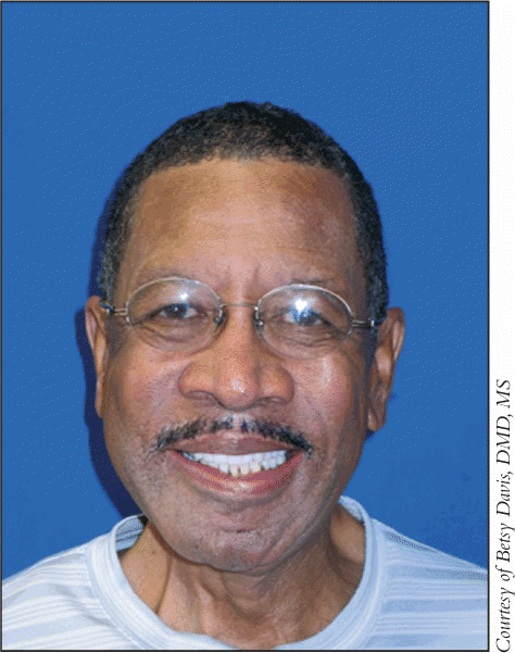 Figure. AFTER: Cancer patient with fibular reconstruction of the lower jaw with resection prosthesis in place.