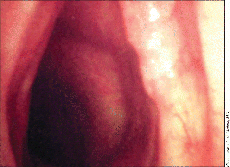 Figure 1. A 52-year-old man presented with a lesion that involved the anterior two-thirds of the left vocal cord but the anterior commissure was not involved.