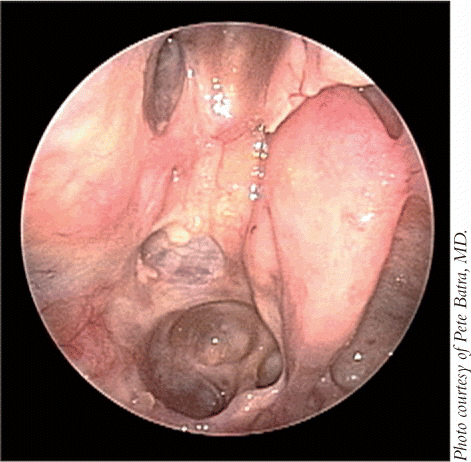 Figure. Endoscopic view of the healed sinonasal cavity four years after resection of sinonasal carcinoma in a 70-year-old patient.