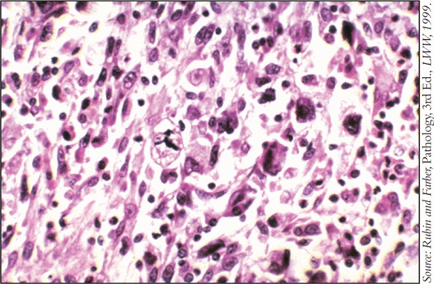Figure. Image of a malignant fibrous histiocytoma