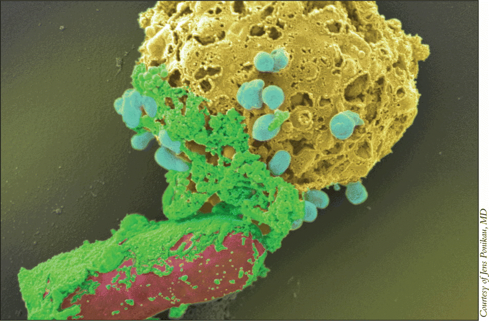 Figure. An eosinophil (yellow) degranulates on a piece of fungus (red) and attacks it by smearing its toxic protein (major basic protein, green) onto the fungus.