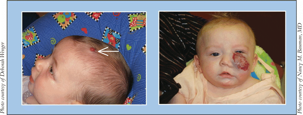 Figure. (Left) Infant with small asymptomatic hemangioma of scalp; (right) Infant with large periorbital hemangioma of cheek obstructing visual axis.