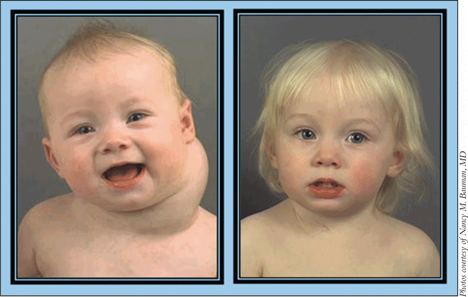 Figure. Baby with massive lymphatic malformation on the neck (left); postoperatively, after treatment with OK-432 (right).
