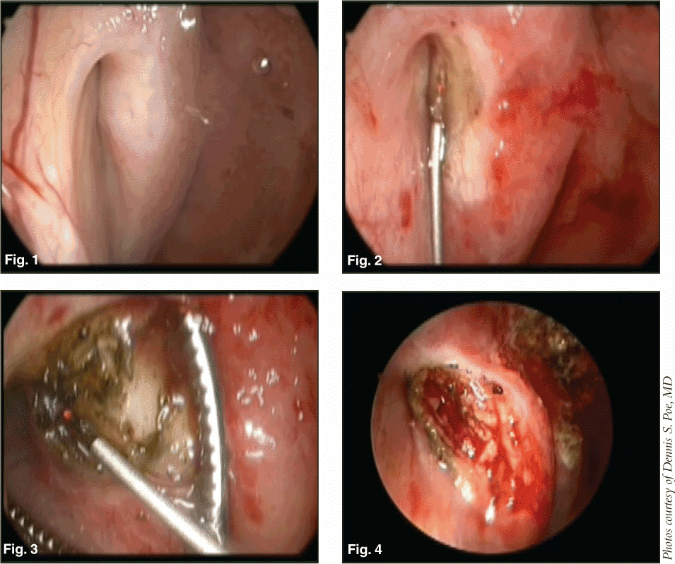 Fig. 1. Preoperative transnasal endoscope view of right eustachian tube orifice before eustachian tuboplasty. The valve mucosa is thickened, especially on the anterolateral wall adjacent to the posterior cushion (torus tubaris).Fig. 2. Initial debulking for mucosa and submucosa is done on the anterolateral wall with cautery and a KTP laser.Fig. 3. Submucosal debulking is done higher inside the valve, sparing the mucosa to avoid cicatrix formation.Fig. 4. Completed eustachian tuboplasty.