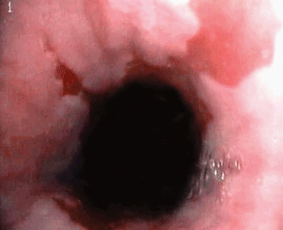 Figure. One of many uses for transnasal esophagoscopy is for the detection and surveillance of Barrett's esophagus (shown) to ensure that the disease has not become cancerous.