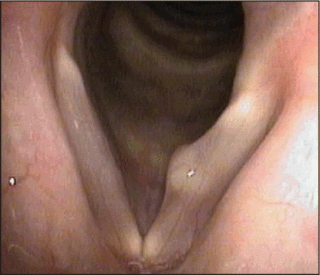 Figure 2. Keratin cyst on the right vocal fold.
