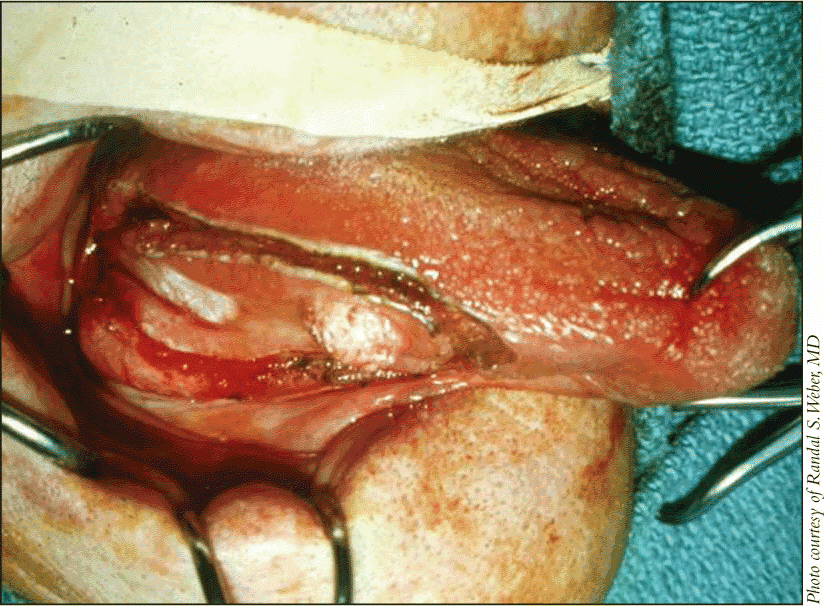 Figure. Early tongue cancer procedures have come under scrutiny at M. D. Anderson, where surgeons have established performance measures and reviewed how well they have done. Such reviews should become standard practice throughout head and neck surgery divisions, many surgeons say