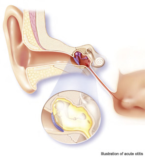 Illustration of acute otitis
