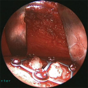 Figure 5:  Intraoperative view after reduction of fracture, secured with two-squared mini-plate and screws. Bone fragments have been added back to the anterior frontal sinus wall.