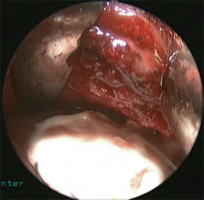 Figure 6: Intraoperative view after placement of hydroxyapatite cement, used to cover bony defects, plate and screws.