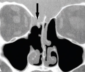 A common site of injury during functional endoscopic sinus surgery is the right lateral lamella (arrow in A) when resecting the right middle turbinate.