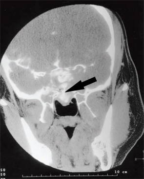 CT cisternography demonstrating a CSF leak (black arrow).