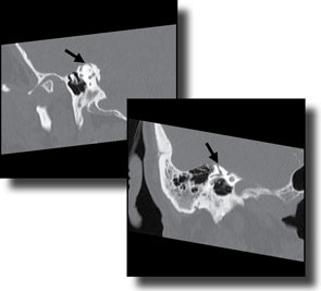 CT scan of right superior semicircular canal, in the Pöschl (a) and Stenvers (b) views, demonstrating a dehiscence.