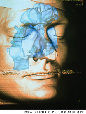 Three-dimensional computed tomography (CT) scan showing the sinuses (blue).