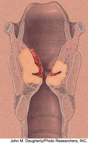 Illustration of stage IV laryngeal carcinoma in both the glottic and supraglottic regions of the larynx.