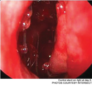 Control stent on right at day 0.