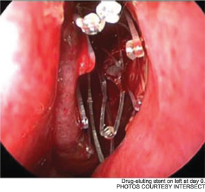 Drug-eluting stent on left at day 0.