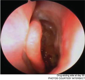 Drug-eluting side at day 30.