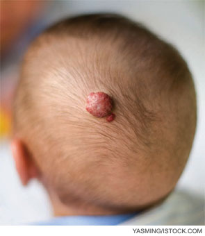 Hemangiomas are estimated to occur in 5 to 10 percent of infants.