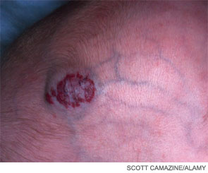 Hemangioma of the scalp.