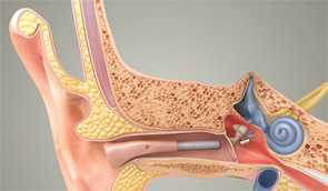 An image of the MAXUM hearing implant, which uses a speaker to amplify sound.